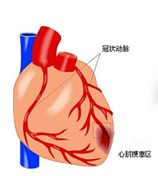 心肌梗塞患者常见的临床表现