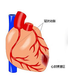 心肌梗塞的治疗--限制及缩小梗死面积