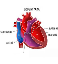 小儿先心病的5个致病因素