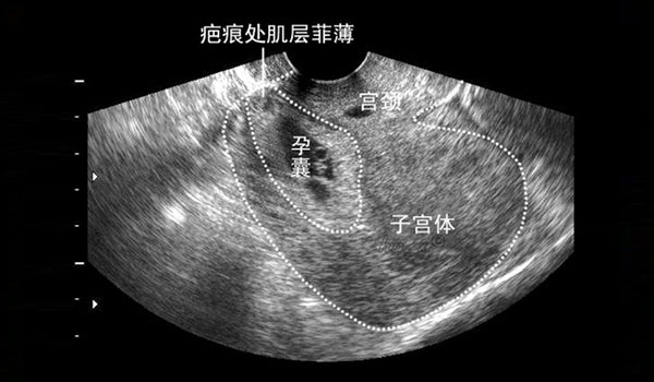 生二胎,当心瘢痕妊娠这个"雷"