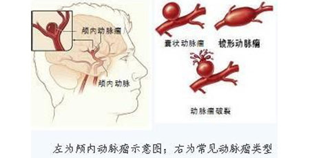 脑动脉瘤非肿瘤"切"急不得!