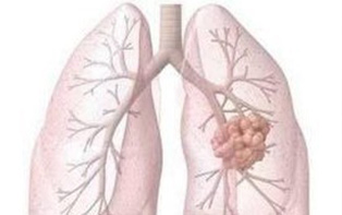 肺癌，到底能不能切？得听TA的……